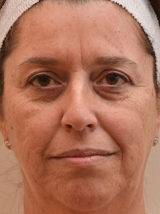 Έτσι κοίταξα πριν χρησιμοποιήσω την κρέμα eudalie