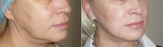 Φωτογραφία μετά την εφαρμογή της διαδικασίας