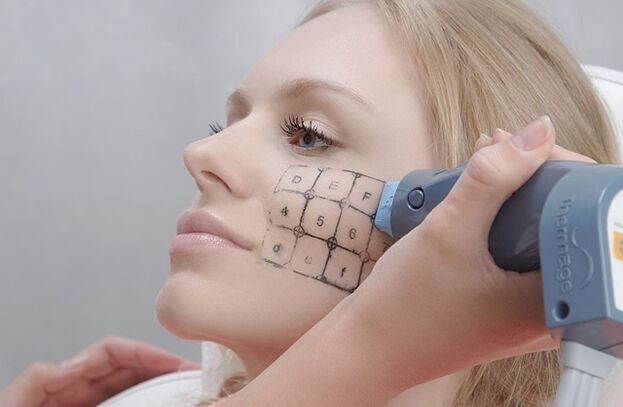 Διαδικασία Thermage